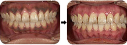 歯ぐきのメラニン（黒ずみ）除去