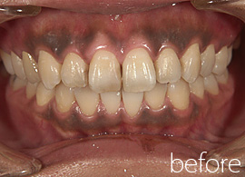 歯茎のメラニン除去症例 治療前