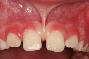 上唇小帯が原因のすきっ歯